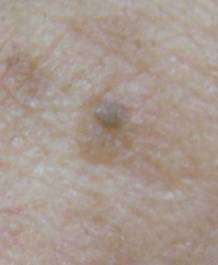 隆起性のシミ、平らなシミ、ホクロその他の良性腫瘍にお悩みの方へ。