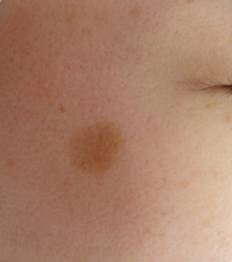 隆起性のシミ、平らなシミ、ホクロその他の良性腫瘍にお悩みの方へ。